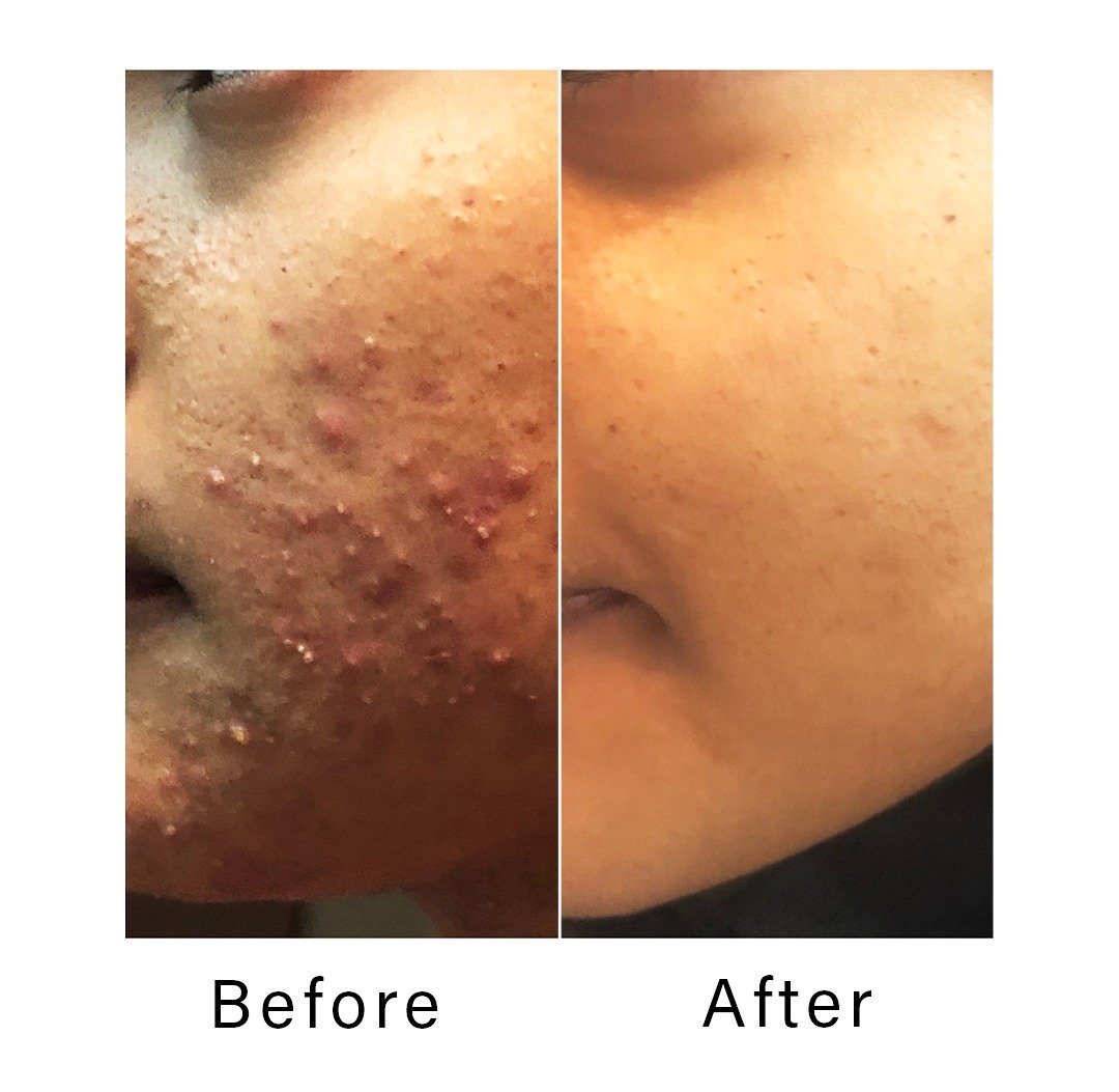 Acne-_best-dermatologist.jpeg
