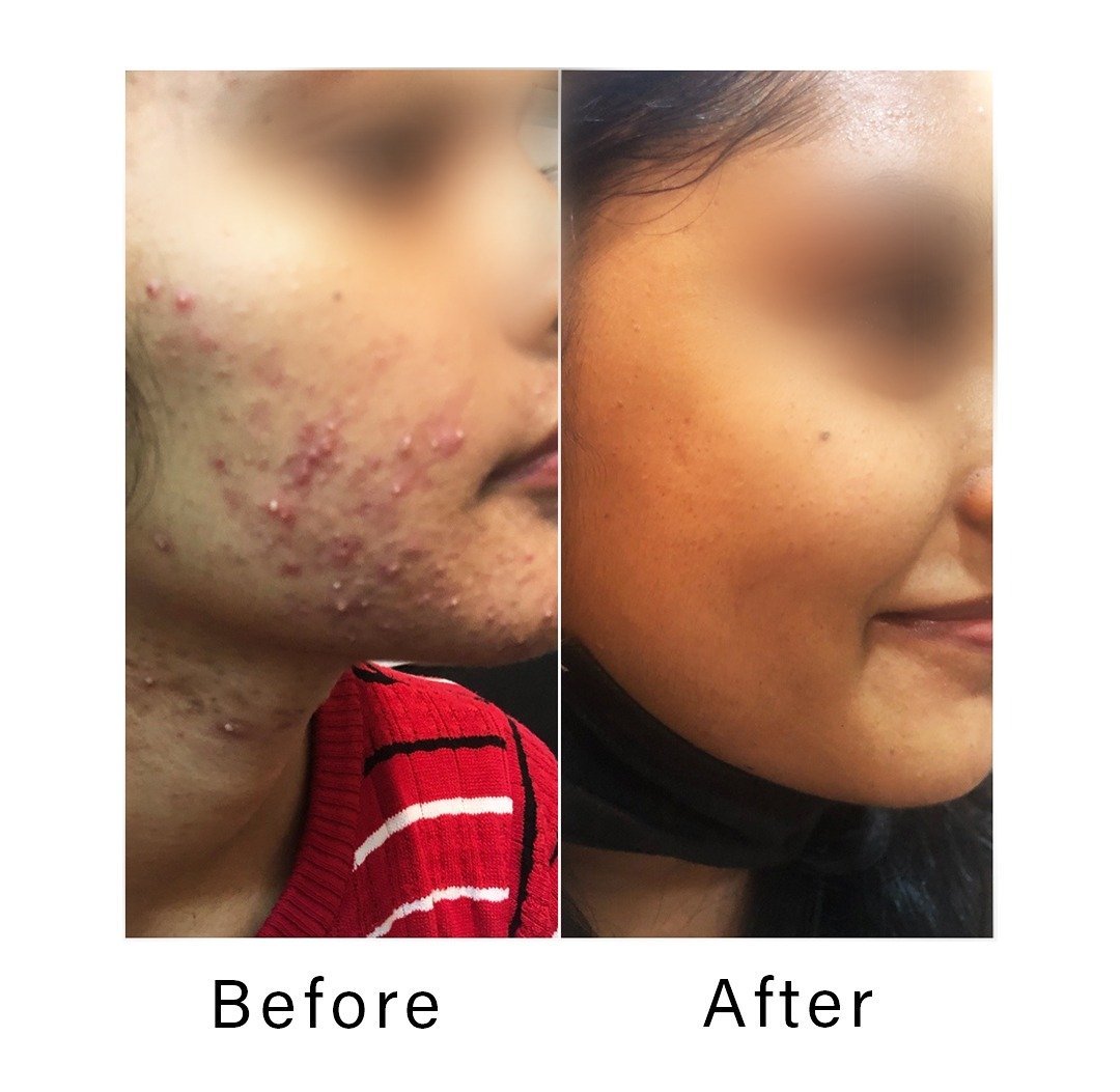Acne-treatment_kiransclinic.jpeg